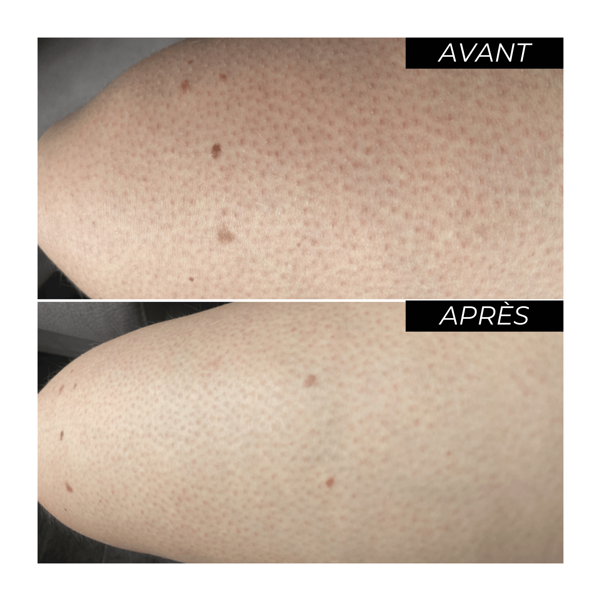 Rituel K ratose Pilaire Duo Acide Glycolique Et Cr me Hydratante ENO Rituel K ratose Pilaire Duo Acide Glycolique Et Cr me Hydratante ENO